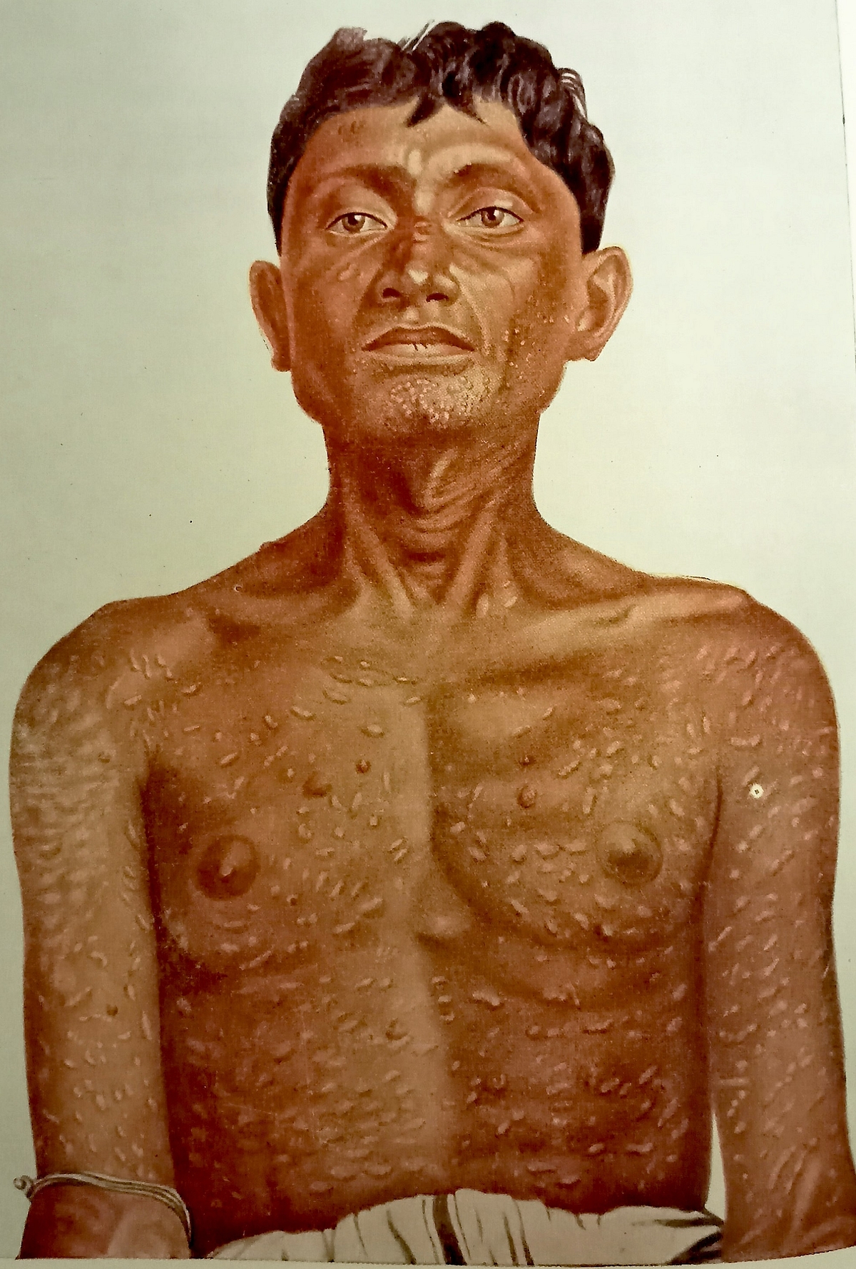 Figure 5. Brahmachari’s Dermal Leishmaniasis (From ‘Gleanings From My Researches’, by Upendranath Brahmachari, Calcutta University Press, 1940)