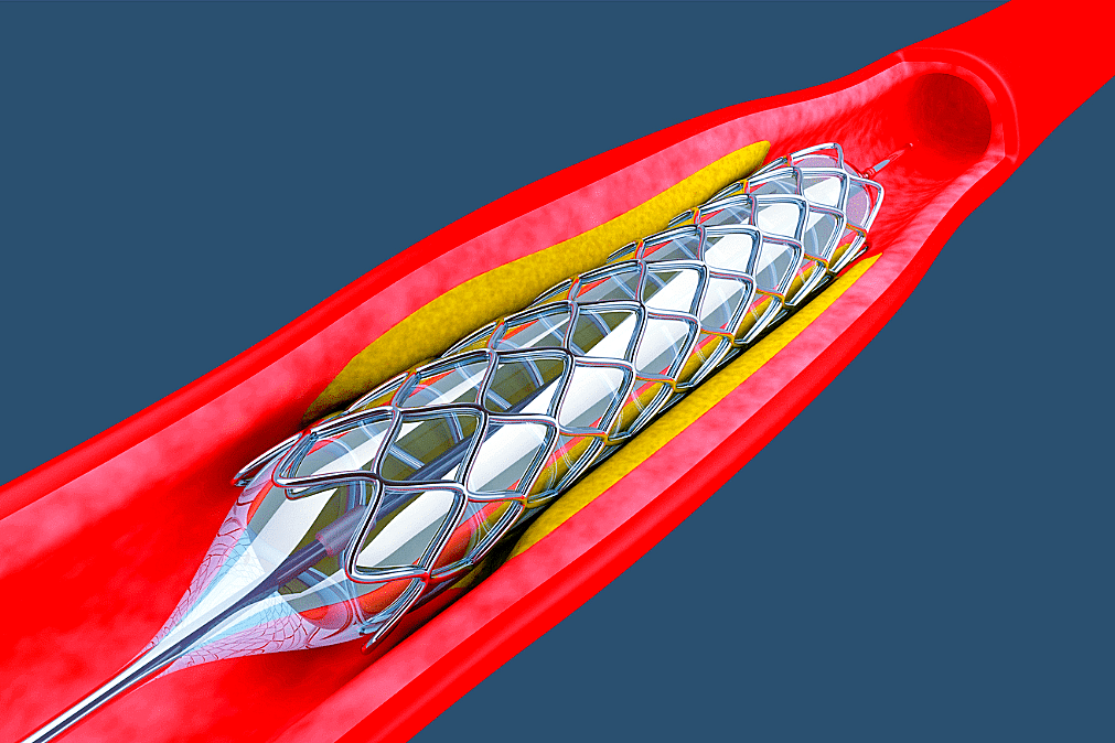 The capping of stent prices was aimed at ending an unhealthy practice of hospitals getting a fixed amount as a cut from medical equipment companies for using their devices. 