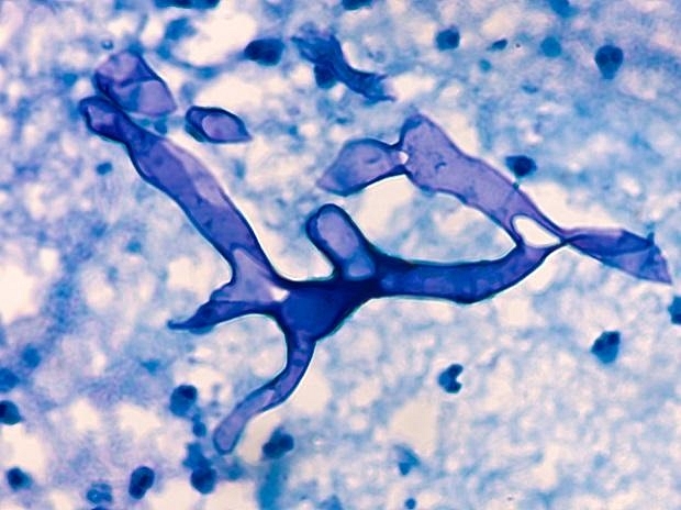 DCGI Studying Use Of Alternate Drugs Other Than Amphotericin B To Treat Mucormycosis: Report