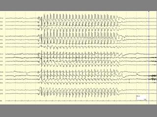 The EEG, a monitor of brain activity, during a seizure. In the left and right corners of the EEG tracing is the normal functioning of the brain. In the center is the rhythmic activity that characterizes a seizure. (www. epilepsydiagnosis.org)