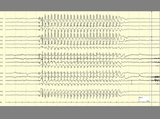 The EEG, a monitor of brain activity, during a seizure. In the left and right corners of the EEG tracing is the normal functioning of the brain. In the center is the rhythmic activity that characterizes a seizure. (www. epilepsydiagnosis.org)