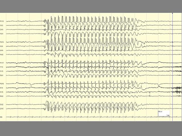 The EEG, a monitor of brain activity, during a seizure. In the left and right corners of the EEG tracing is the normal functioning of the brain. In the center is the rhythmic activity that characterizes a seizure. (www. epilepsydiagnosis.org)