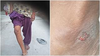 Some pictures of wounds sustained by dalit family, as claimed