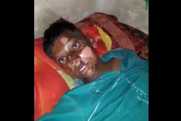 16-year-old Rahul Giri was attacked with an acid-like substance during Delhi riots 