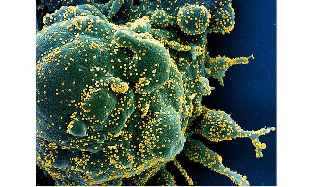 Colorized scanning electron micrograph of an apoptotic cell (green) heavily infected with SARS-COV-2 virus particles (Pic via NIH website)