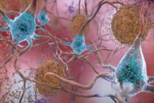 Alzheimer’s disease is an irreversible, progressive brain disorder that slowly destroys memory and thinking skills. (Pic Via NIA Website)