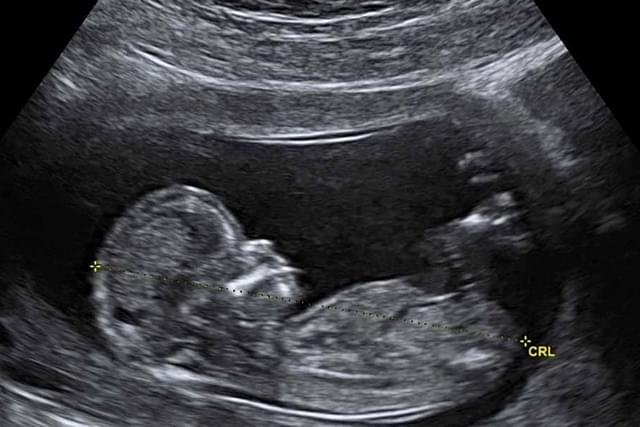An unborn in the womb (Representative Image)